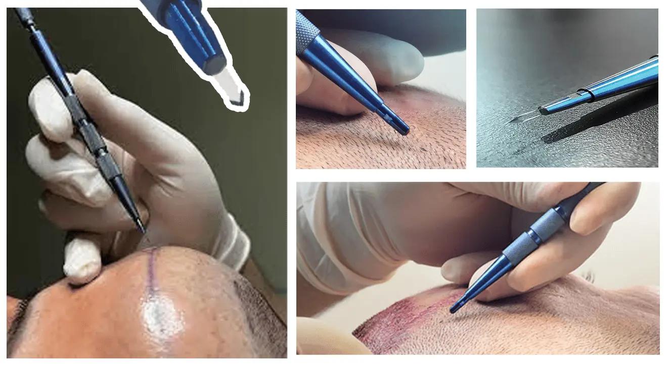 Sapphire Blade in Hair Transplant