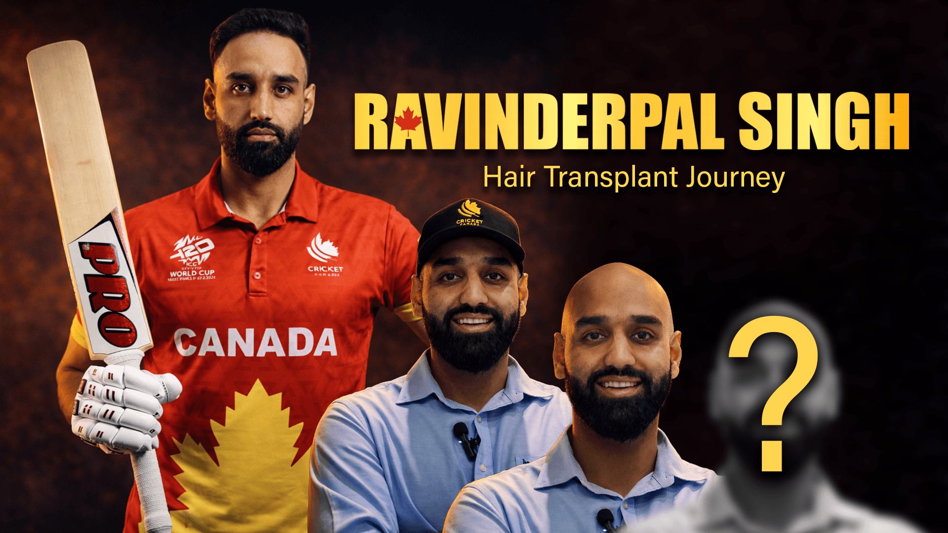 ravinderpal singh hair transplant
