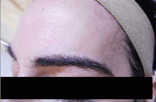 Reconstruction of eyebrows with Revision-FUE.