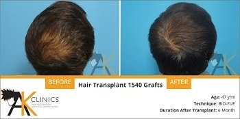 NW Grade 3V Patient Result