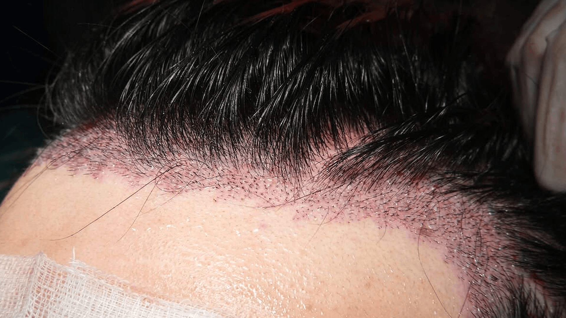 direct hair transplant technique