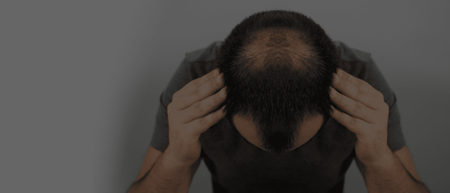 hair-loss-banner