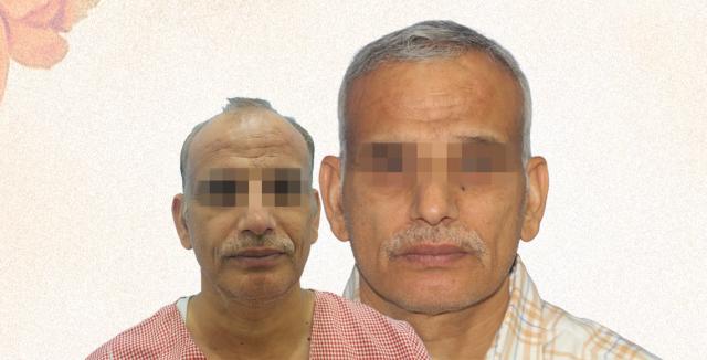 Hair Transplant Case Study: A 50-Year-Old Man’s Journey to Hair Restoration