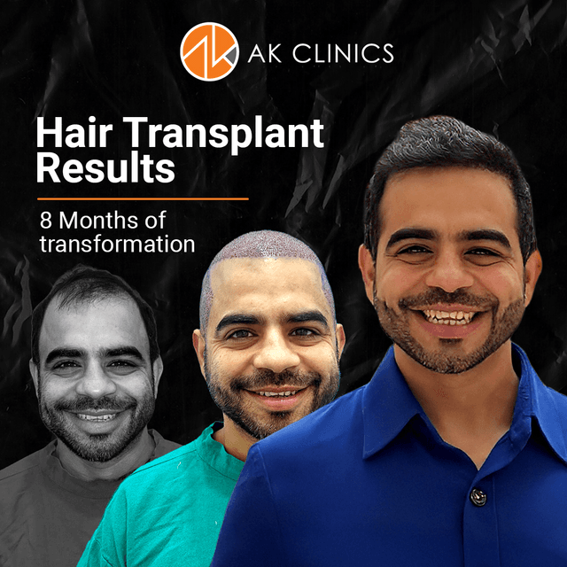 Hair Transplant Cost in Delhi (2026): Graft-Wise Pricing, Techniques & Full Cost Breakdown