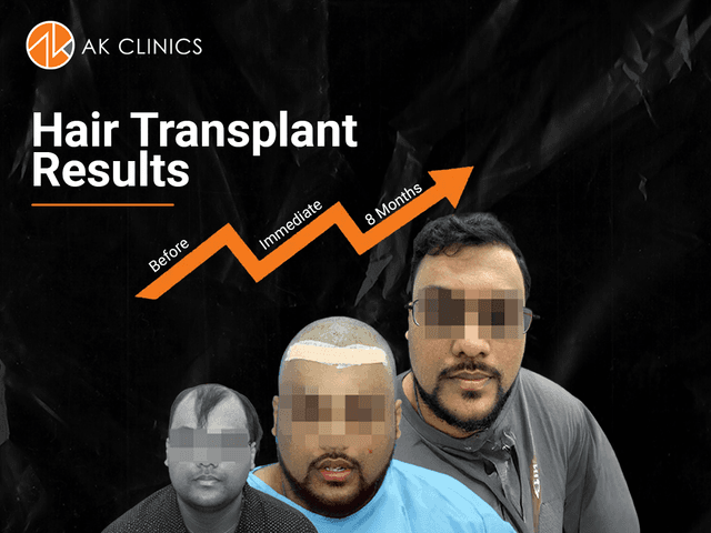 Hair Transplant Cost in Chandigarh (2026): Graft-Wise Pricing & Techniques