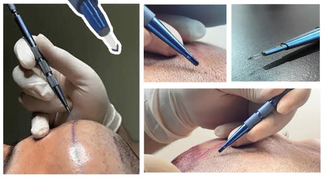 Sapphire Blade in Hair Transplant