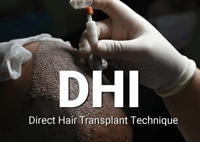 Direct hair transplant technique