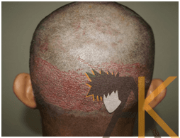 baldness