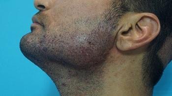 beard case study