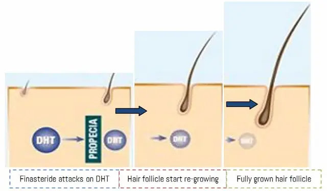 Finasteride-attacks-on-DHT