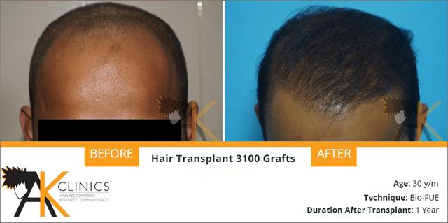 hair-result-3100