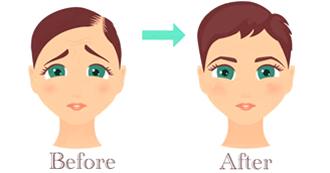 prp-treatments