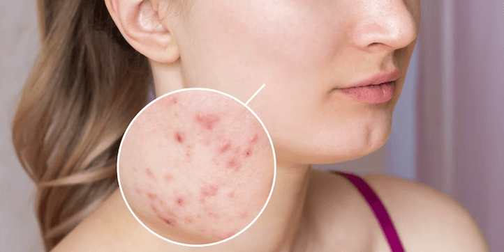 what-is-acne
